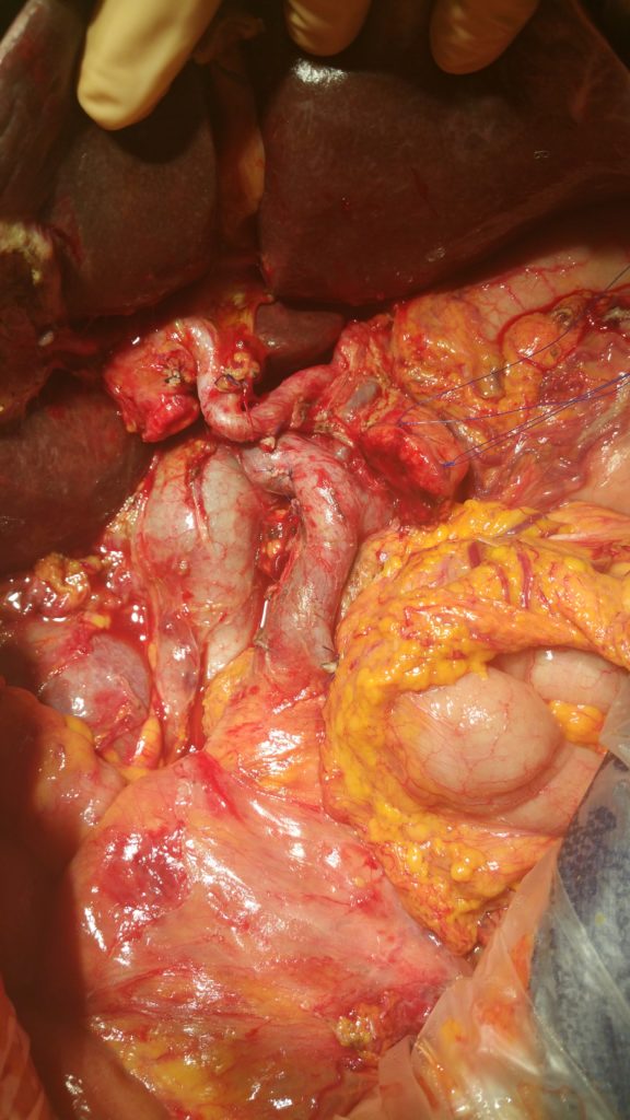 Duodenocefalopancreasectomia tumore pancreas whipple Riccardo Memeo