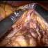 Robotic distal pancreatectomy Waeshaw technique