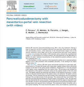 Pancreaticoduodenectomy with mesenterico-portal vein resection (with video)