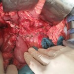 pancreatic surgery frey procedure