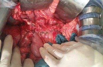 pancreatic surgery frey procedure