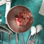 pancreatic surgery frey procedure pancreatic lithiasis
