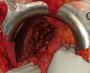 Epatectomia sinistra, tumore al fegato