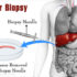 liver-biopsy