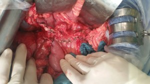 pancreatic surgery frey procedure